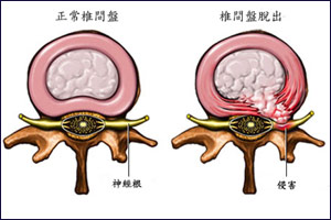 治療椎間盤突出的三個(gè)瑜伽方法