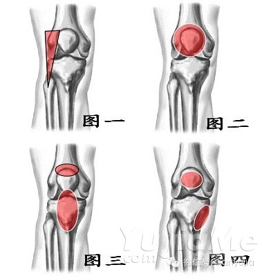 膝關(guān)節(jié)不同部位的疼痛